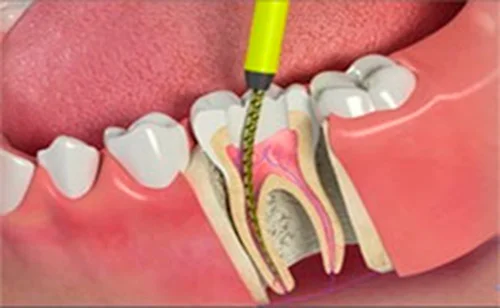 Extracción de una Endondoncia